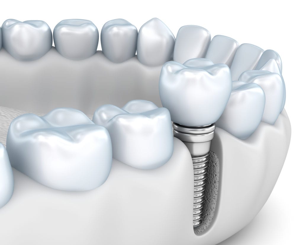 Implant Dentistry in Downtown Chicago
