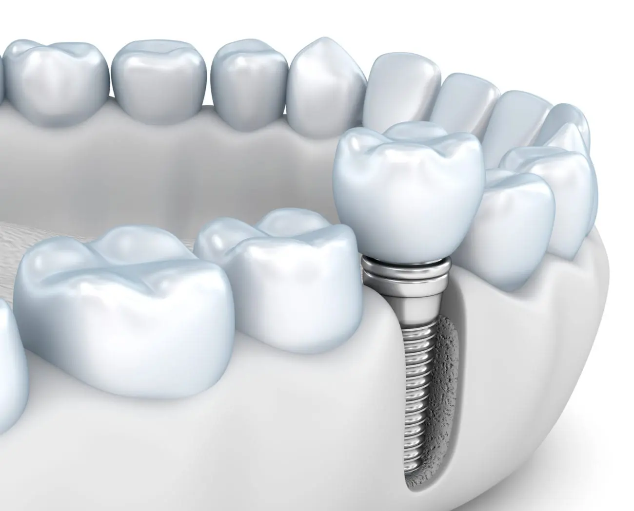 dental implants in Downtown Chicago IL