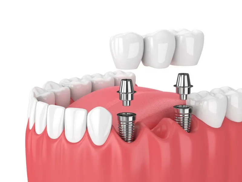 Dental Bridge Treatment in Chicago, Illinois