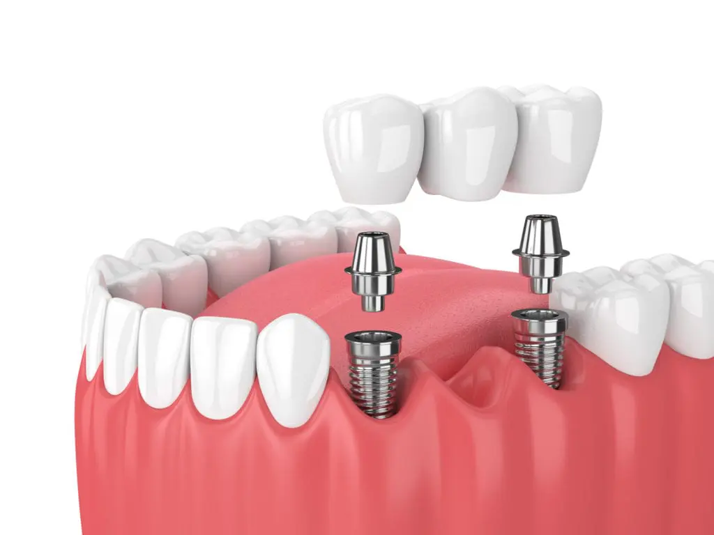 Denture Treatment in Chicago, Illinois