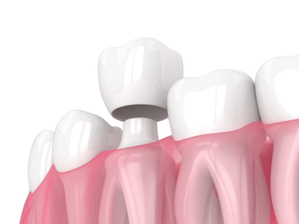 Dental Crowns in Chicago, Illinois