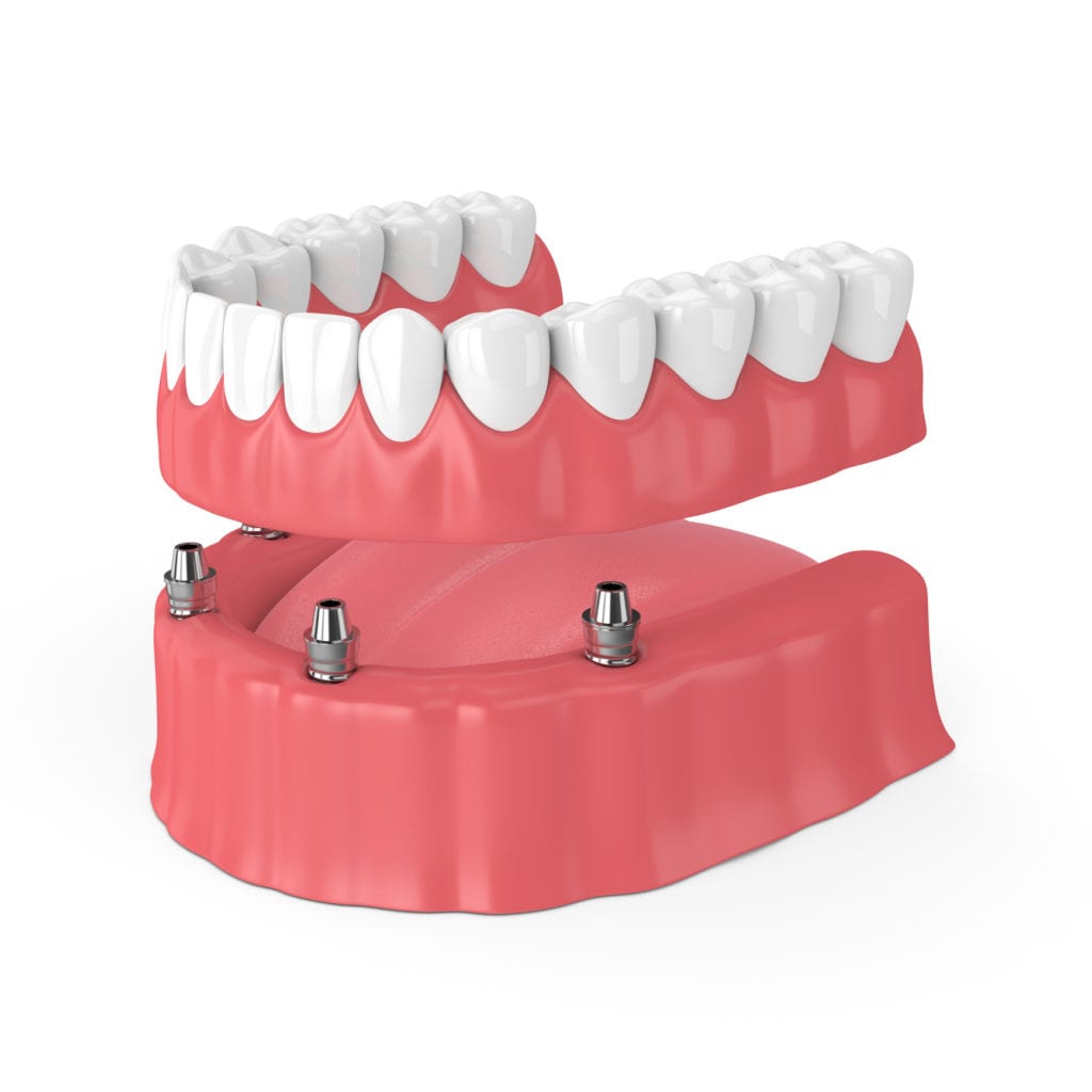 Implant Dentures in Chicago