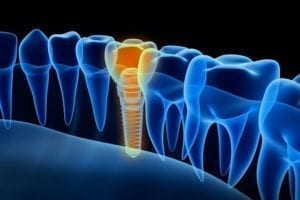 types of dental implants in Chicago Illinois