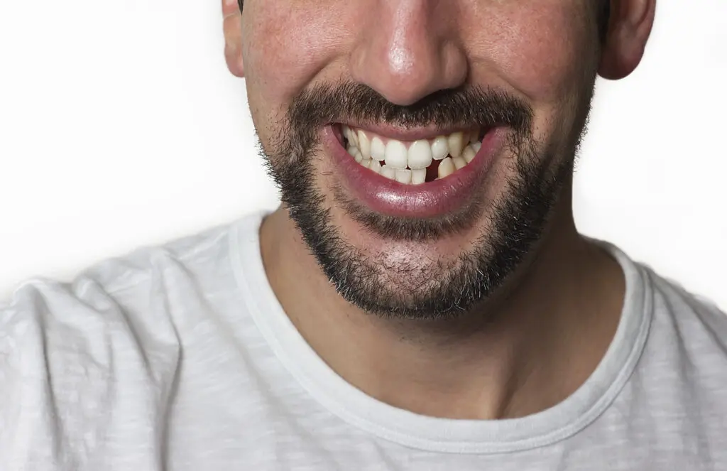 zoomed image of a man missing an incisor on his bottom row of teeth tooth extraction dentist in Chicago Illinois