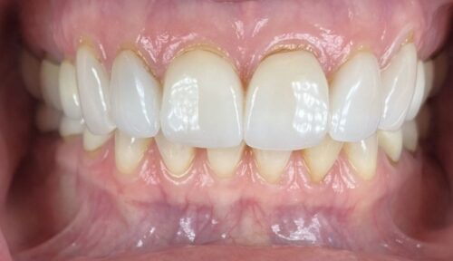 before cosmetic dentistry in Chicago, IL