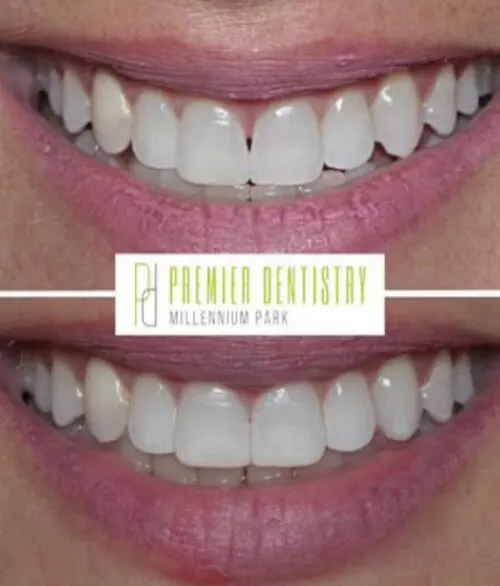 Premier chicago 22 - Cosmetic Dentistry Before & After Photos