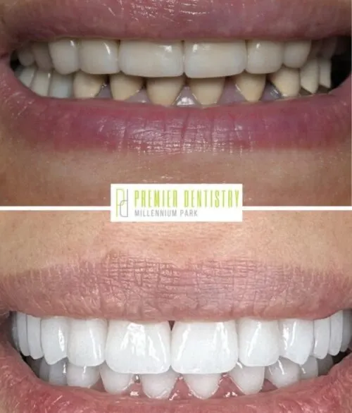 Premier chicago 23 - Cosmetic Dentistry Before & After Photos