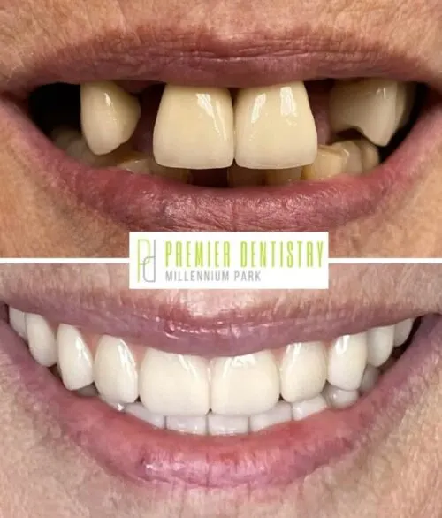 Premier chicago 24 - Cosmetic Dentistry Before & After Photos