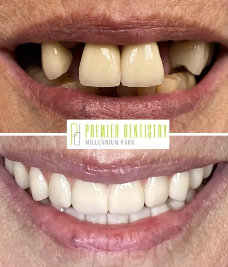 Patient before and after dental implants from Dr. Nechama Brand