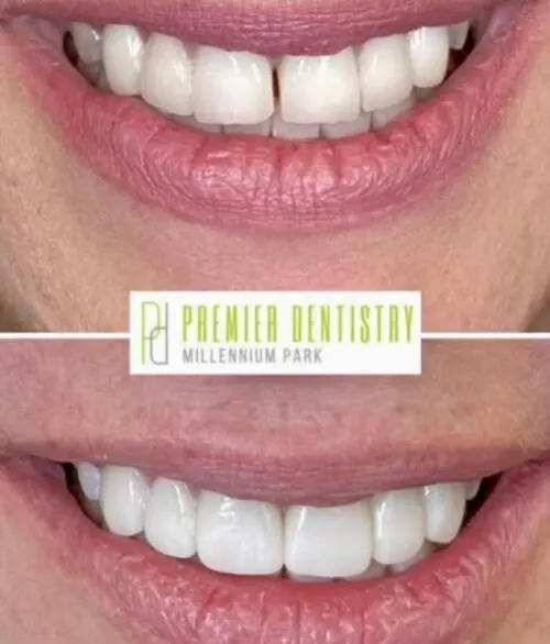 Premier chicago 25 - Cosmetic Dentistry Before & After Photos
