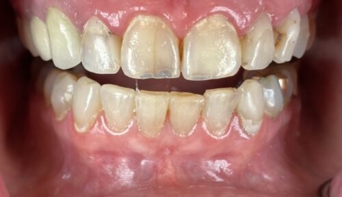 before cosmetic dentistry in Chicago, IL