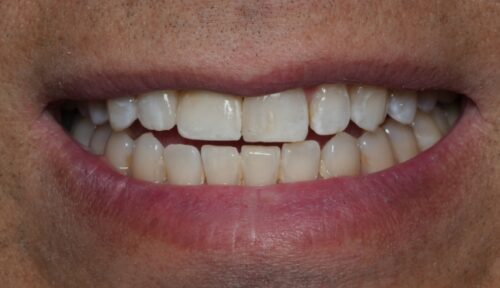 after cosmetic dentistry in Chicago, IL