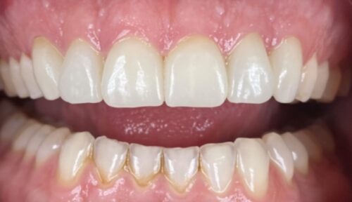 after cosmetic dentistry in Chicago, IL