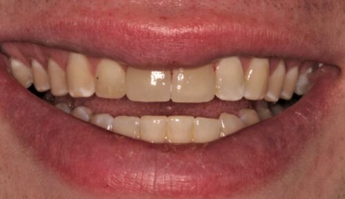 before cosmetic dentistry in Chicago, IL