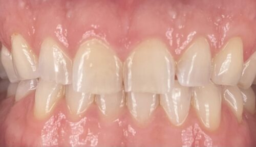 before cosmetic dentistry in Chicago, IL