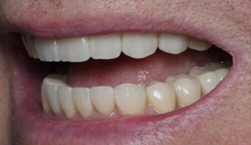 after cosmetic dentistry in Chicago, IL
