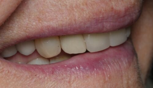 after cosmetic dentistry in Chicago, IL