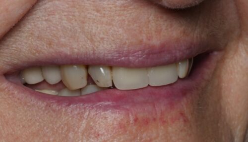 before cosmetic dentistry in Chicago, IL