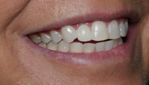 after cosmetic dentistry in Chicago, IL