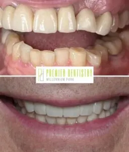 Dental patient before and after getting dental crowns