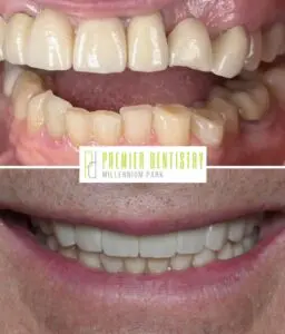 Dental patient before and after getting dental crowns