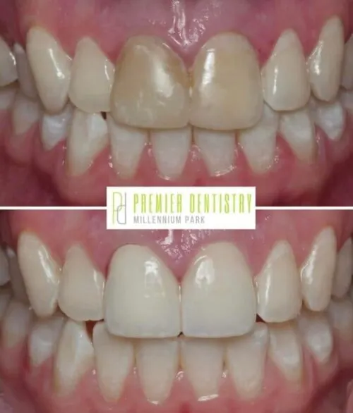 Premier chicago 11 - Cosmetic Dentistry Before & After Photos