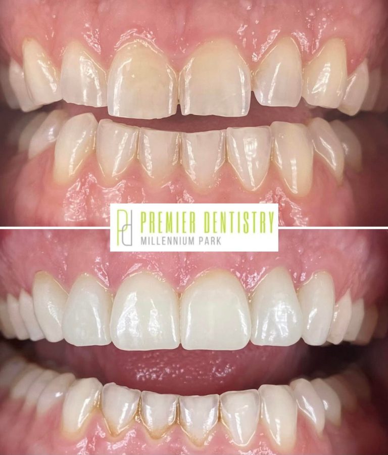 Dental patient before and after veneers and whitening at Premier Dentistry at Millennium Park