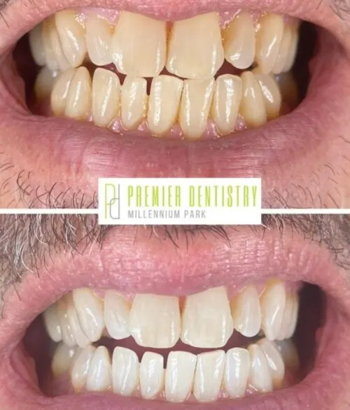 Premier chicago 13 - Cosmetic Dentistry Before & After Photos