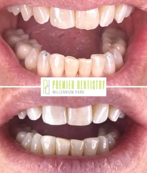 Premier chicago 14 - Cosmetic Dentistry Before & After Photos