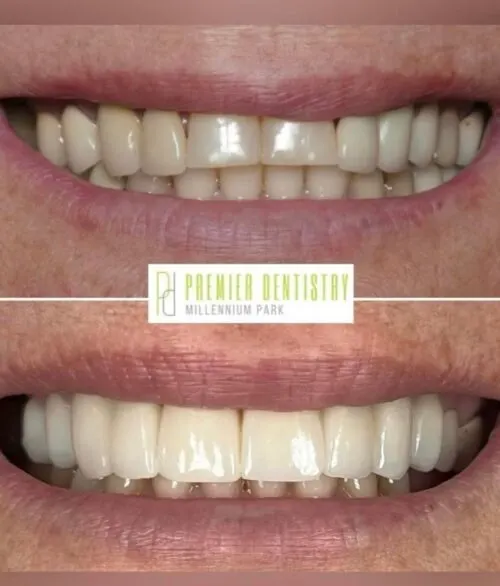 Premier chicago 15 - Cosmetic Dentistry Before & After Photos