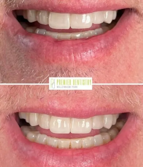 Premier chicago 16 - Cosmetic Dentistry Before & After Photos