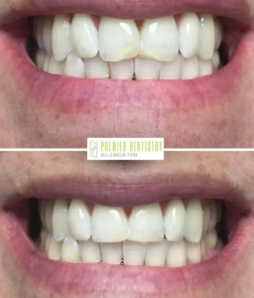Premier chicago 17 - Cosmetic Dentistry Before & After Photos