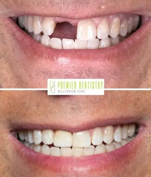 Premier chicago 18 - Cosmetic Dentistry Before & After Photos
