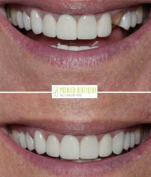 Premier chicago 19 - Cosmetic Dentistry Before & After Photos