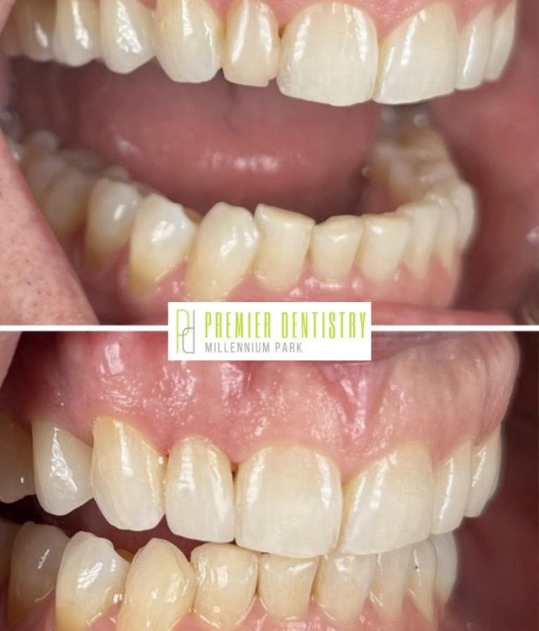 Dental patient before and after dental care at Premier Dentistry at Millennium Park