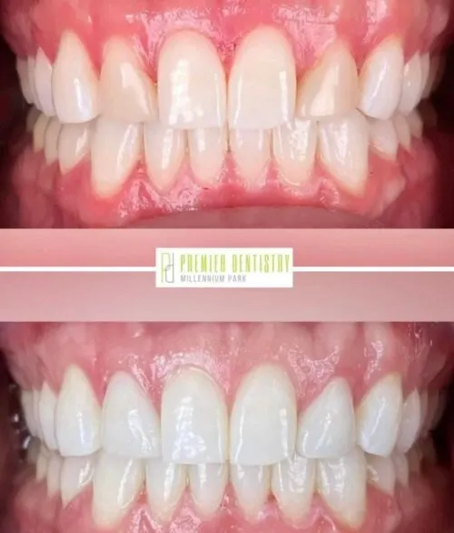 Premier chicago 20 - Cosmetic Dentistry Before & After Photos