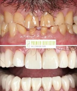 Dental patient before and after porcelain veneers at Premier Dentistry at Millennium Park