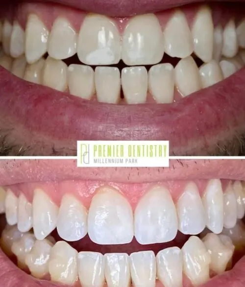 Premier chicago 3 - Cosmetic Dentistry Before & After Photos