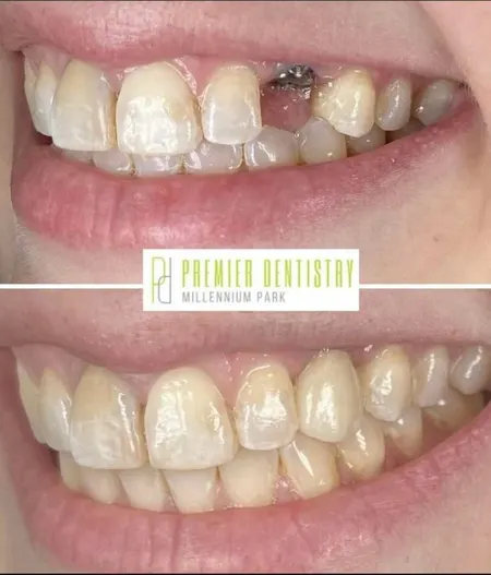 Dental patient before and after getting a dental implant at Premier Dentistry at Millennium Park