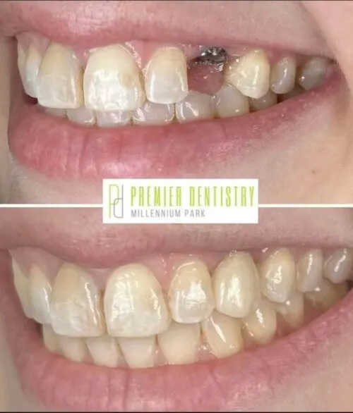Premier chicago 4 - Cosmetic Dentistry Before & After Photos