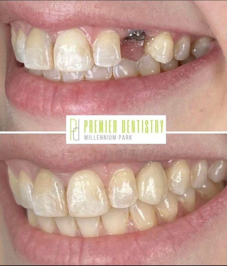 Dental patient before and after getting a dental implant at Premier Dentistry at Millennium Park