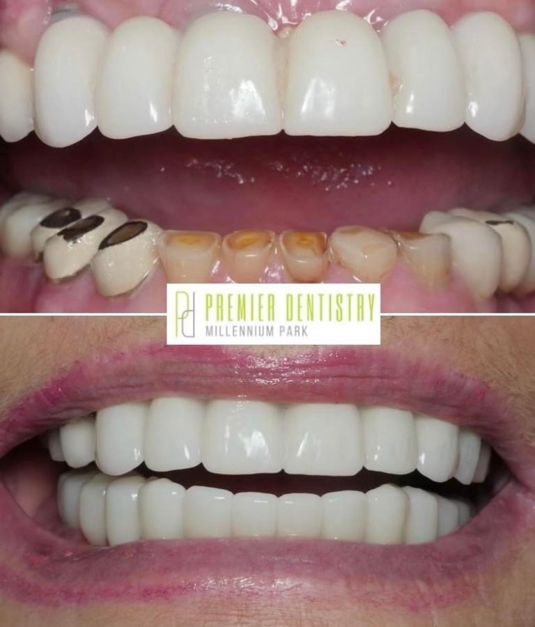 Dental patient before and after restorative care at Premier Dentistry at Millennium Park