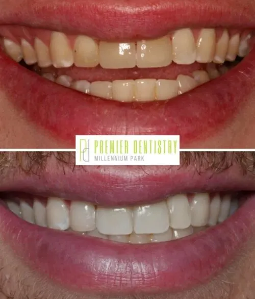 Premier chicago 6 - Cosmetic Dentistry Before & After Photos