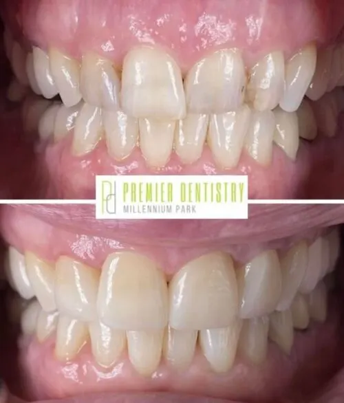 Premier chicago 8 - Cosmetic Dentistry Before & After Photos