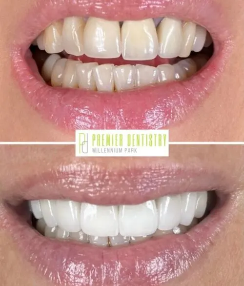 Premier chicago 9 - Cosmetic Dentistry Before & After Photos