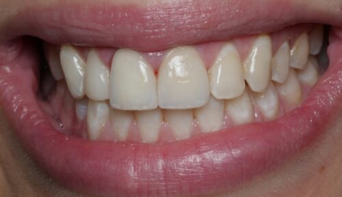 after cosmetic dentistry in Chicago, IL