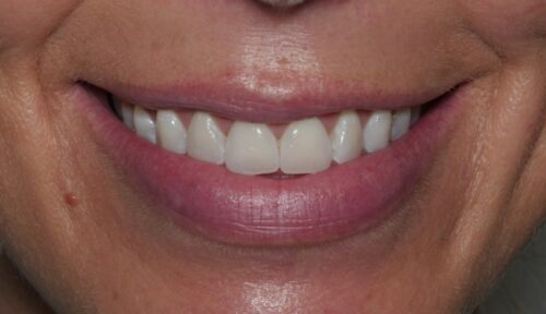 after cosmetic dentistry in Chicago, IL