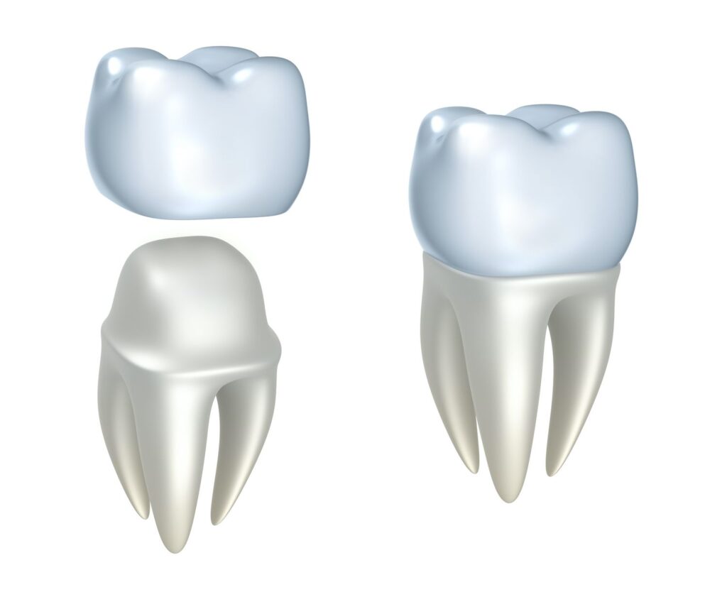 Dental Crowns for Dental Erosion