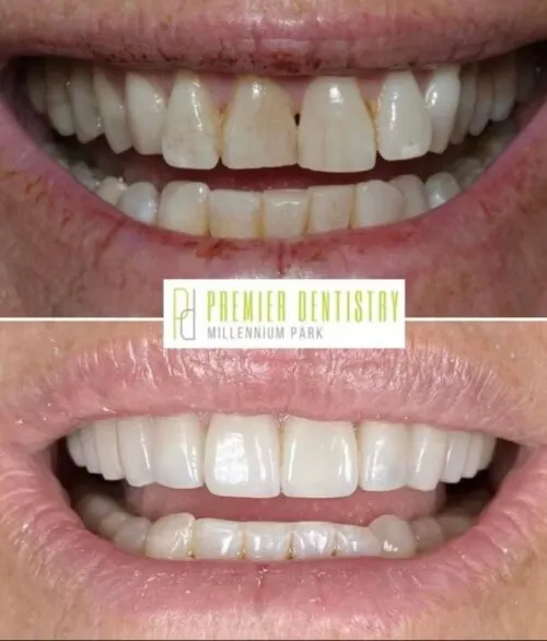 Premier chicago 27 - Cosmetic Dentistry Before & After Photos