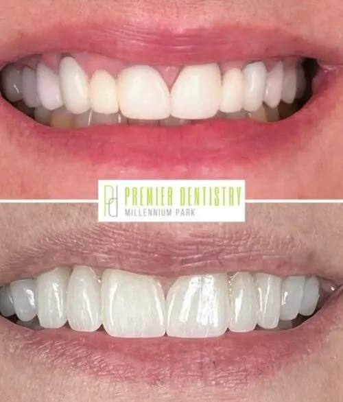 Premier chicago 28 - Cosmetic Dentistry Before & After Photos